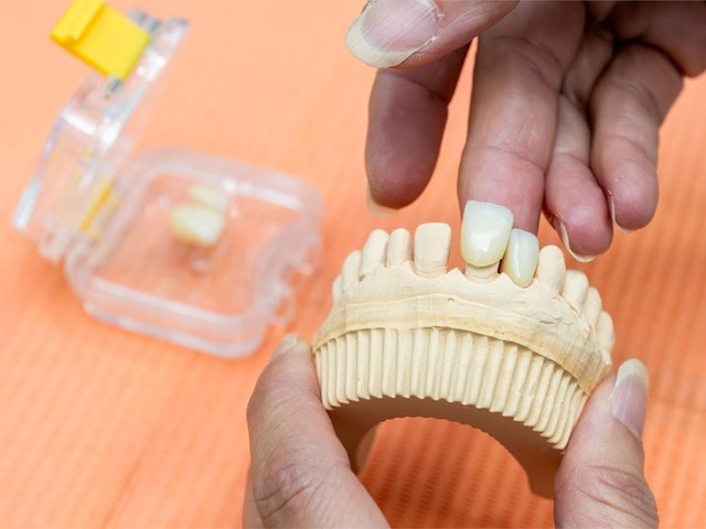 ¿Se pueden poner a la vez varios implantes dentales?