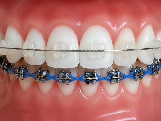 Sonríe con seguridad: ortodoncia con brackets metálicos o de zafiro en Milladoiro