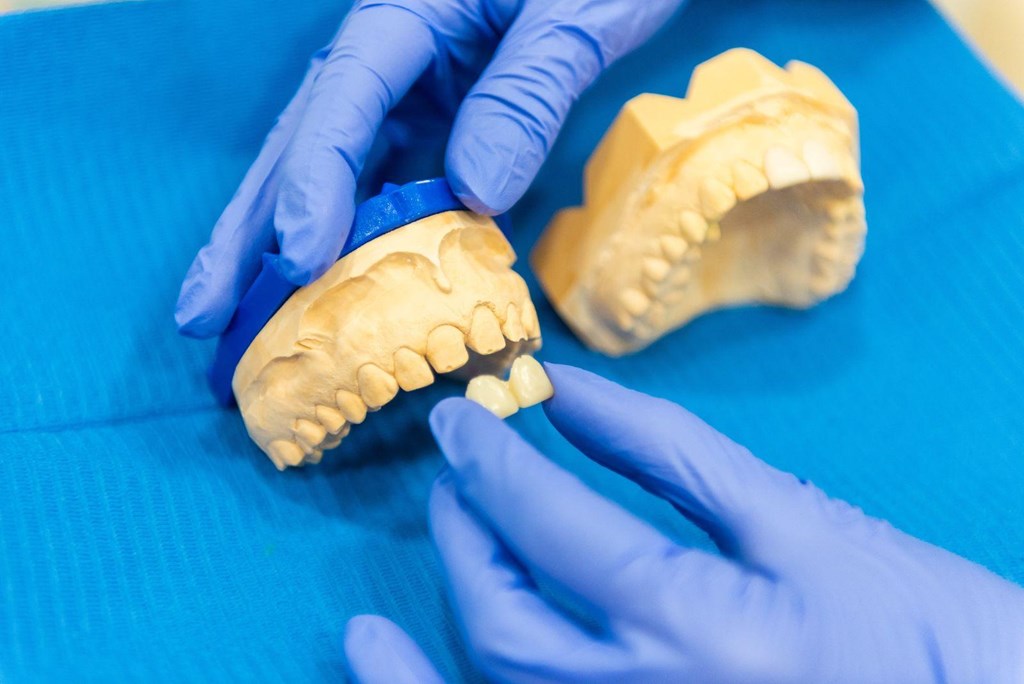 Foto 1 Sonrisa firme y natural con puentes y coronas de zirconio en Milladoiro