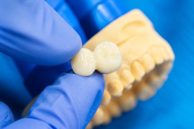 Sonrisa firme y natural con puentes y coronas de zirconio en Milladoiro - Imagen 1