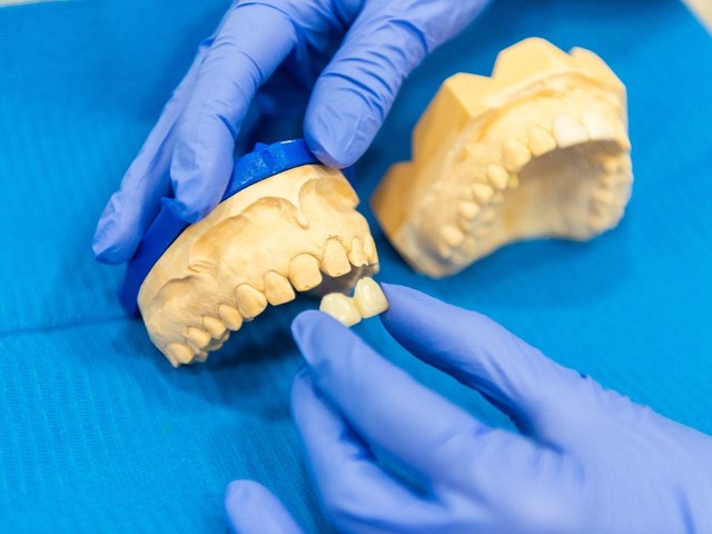 Sonrisa firme y natural con puentes y coronas de zirconio en Milladoiro