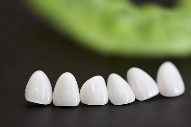 Sonrisa renovada con carillas dentales en Milladoiro - Imagen 1
