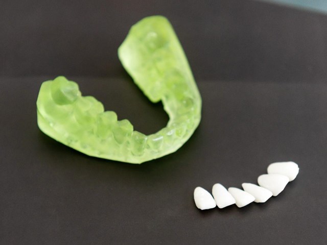 Sonrisa renovada con carillas dentales en Milladoiro