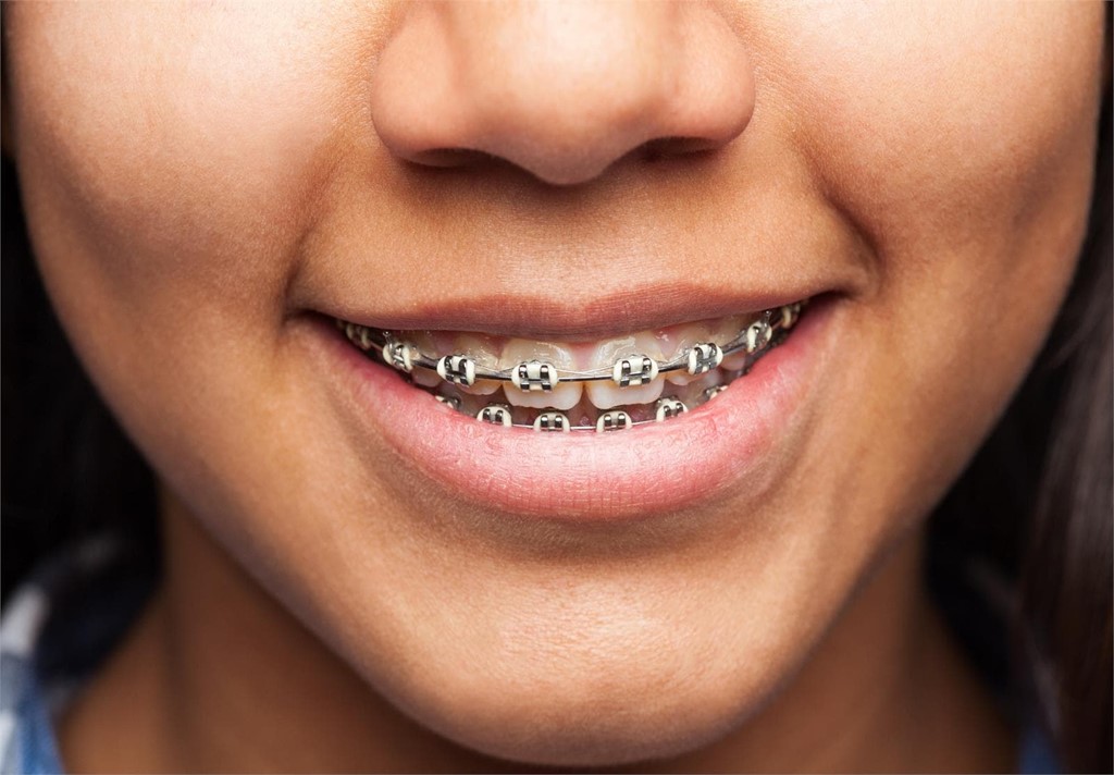 ¿Usas brackets? ¡Realiza una correcta limpieza dental!