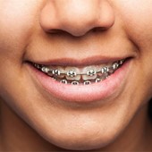 ¿Usas brackets? ¡Realiza una correcta limpieza dental!