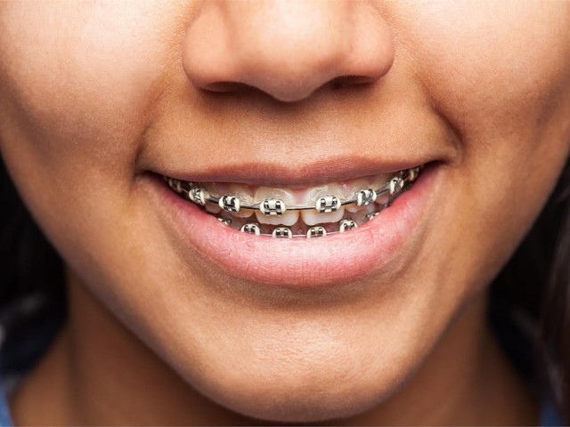 ¿Usas brackets? ¡Realiza una correcta limpieza dental!