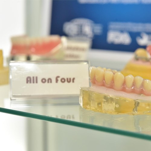 Ventajas del sistema de implantes All On Four frente a otros